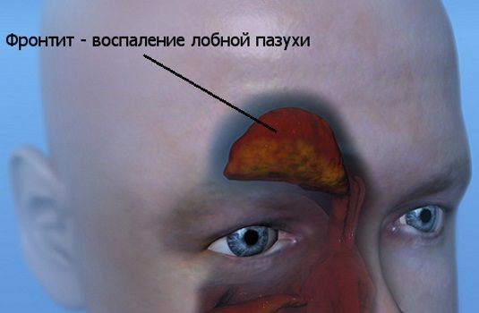 Острый фронтит что такое, симптомы и лечение у взрослых