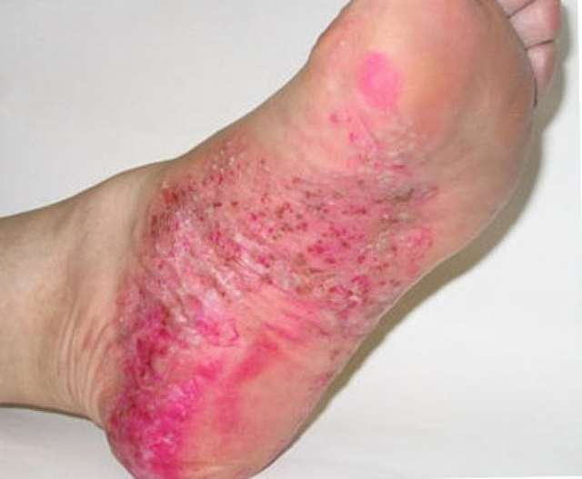 Идиопатическая тромбоцитопеническая пурпура.