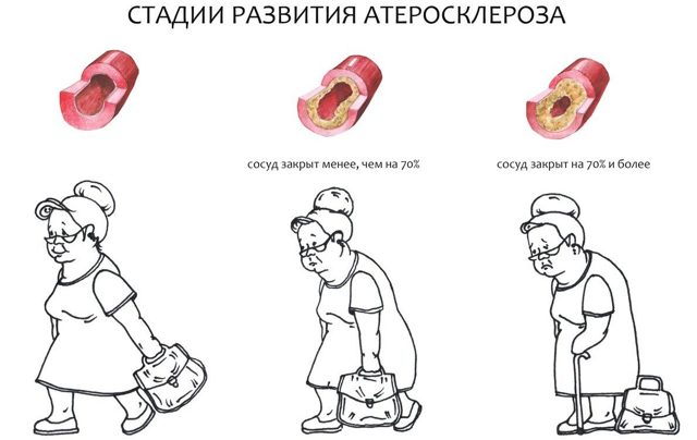 Диагностика атеросклероза