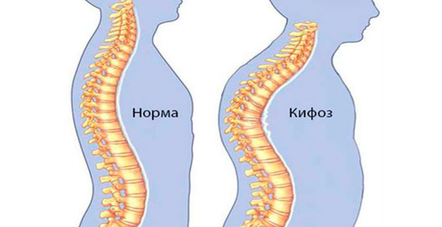 Как убрать горб на спине: эффективные способы лечения