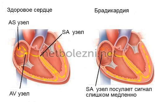 Брадикардия симптомы и лечение, какие таблетки принимать?