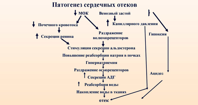 Отеки при сердечной недостаточности - патогенез, симптомы и лечение