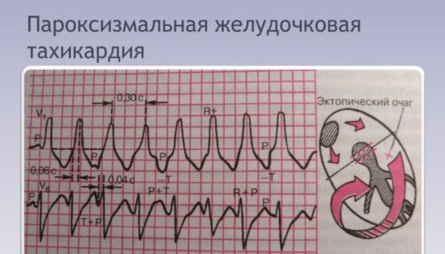 Что такое ТАХИКАРДИЯ ПАРОКСИЗМАЛЬНАЯ ЖЕЛУДОЧКОВАЯ?