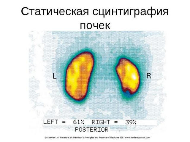 Реноваскулярная гипертензия - лечение, причины