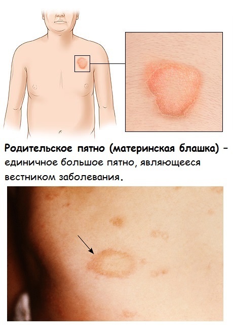 Красные пятна на теле у взрослого - появились красные пятнышки на лице