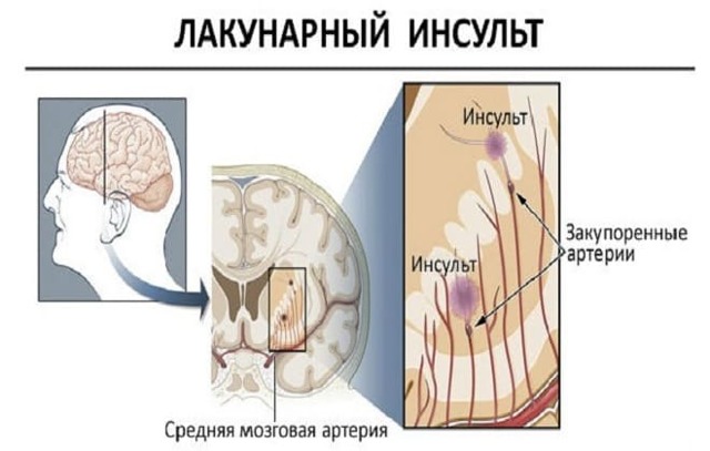 Ишемический инсульт головного мозга: прогноз для жизни. Реабилитация после инсульта