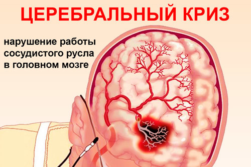 Типы и осложнения гипертонического криза