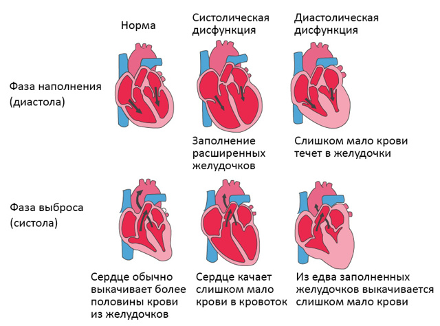 Прогноз при сердечной недостаточности
