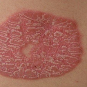 Лечение псориаз на руках - фото, симптомы, виды псориаза на руках