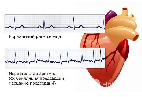 Дилатация камер сердца что это такое - Все про гипертонию