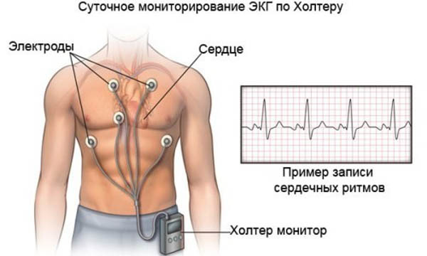 Низкий пульс при нормальном давлении: причины и способы лечения