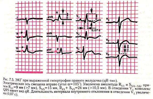 ЭКГ. Гипертрофия правого желудочка. Характерные признаки гипертрофии правого желудочка на ЭКГ