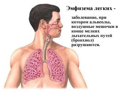 Какие существуют болезни легких