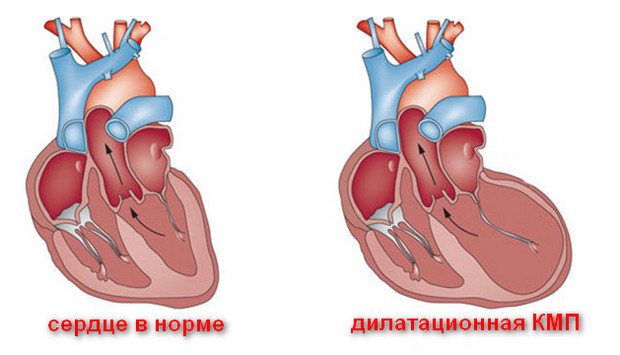 Кардиомиопатия сердца: симптомы и лечение