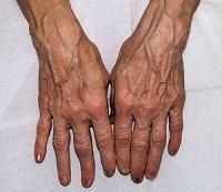 Выступают вены на руках у женщин и мужчин: причины, лечение сильно выпирающих вен