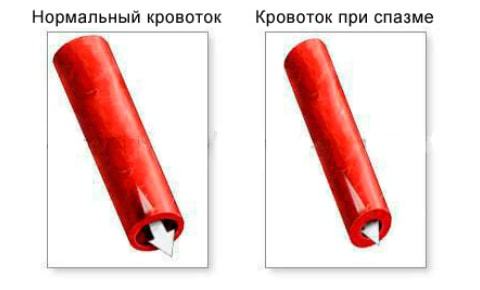 Спазм сосудов головного мозга: симптомы, лечение таблетками, травы снимающие боль и как быстро избавиться от недуга