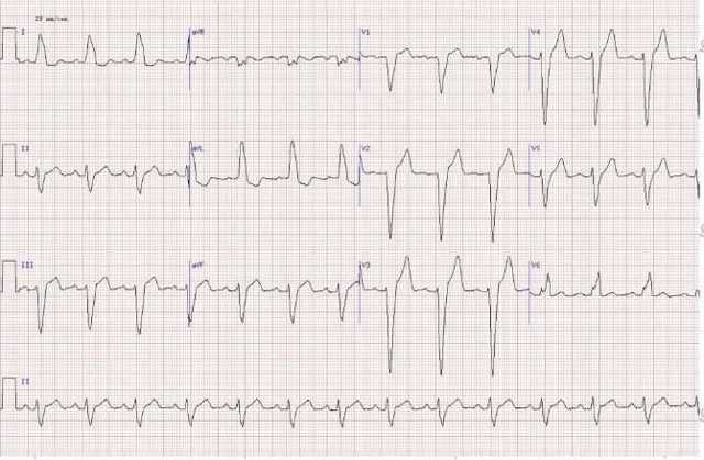 Блокада левой ножки пучка гиса на экг — Сердце