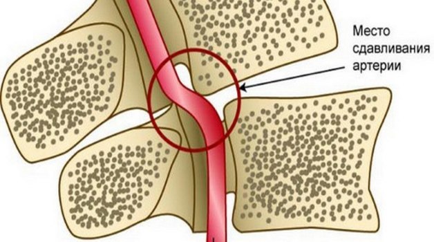 Сосудистые препараты при шейном остеохондрозе и спазме сосудов