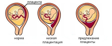 Кровь из влагалища, почему идет кровь из влагалища, после секса, но не месячные, при беременности