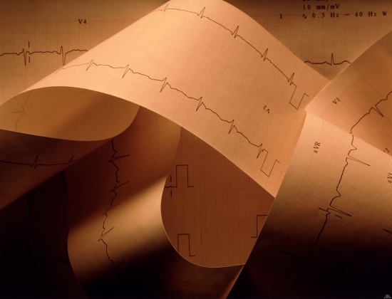 ЭКГ при блокаде правой ножки пучка Гиса (ПНПГ)