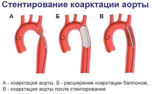 Атеросклероз аорты и алкоголь