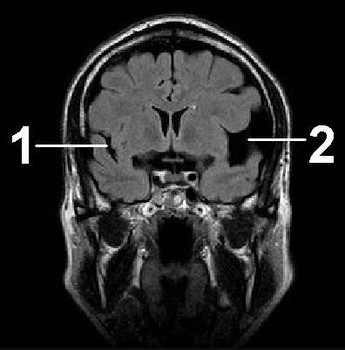 Киста сосудистого сплетения головного мозга: возникновение, диагностика, лечение. Опасна ли киста сосудистого сплетения для новорожденного?