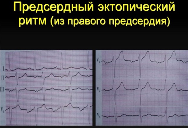 Предсердный ритм норма или патология?
