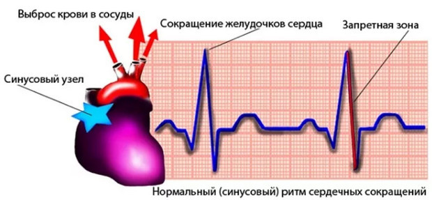 Нерегулярный синусовый ритм сердца