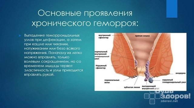 Геморрой при беременности - признаки, симптомы, причины и лечение