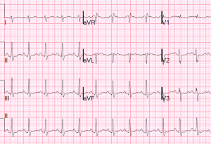 Регулярный и нерегулярный синусовый ритм сердца