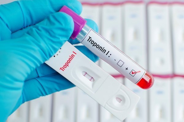 Тропониновый тест при инфаркте миокарда – что это такое: инструкция по проведению и расшифровка теста на тропонин