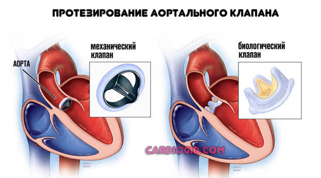 Стеноз аорты: симптомы и медикаментозное лечение