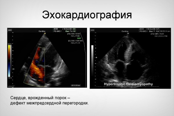 Эхо КГ сердца что это такое, как делают