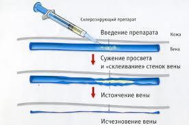 Очень видно вены на руках - Сайт о варикозе