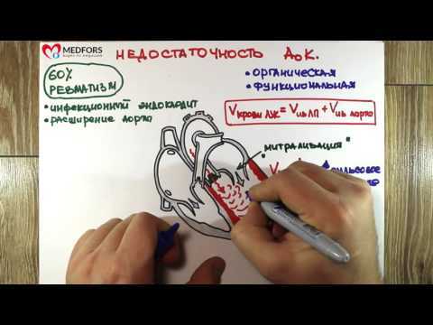 Фиброз створок митрального клапана