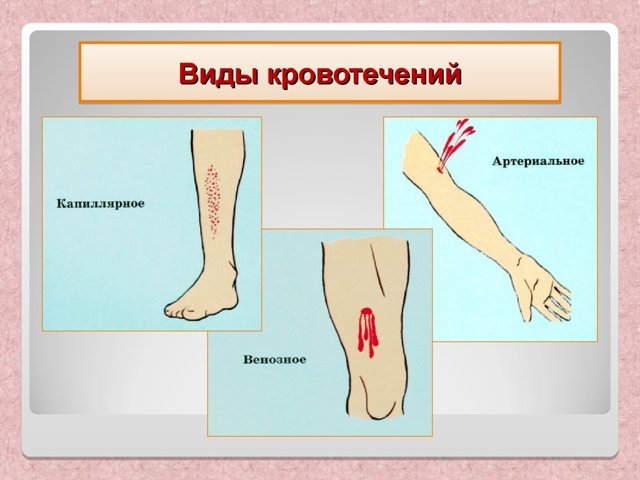Кровотечения и способы их остановки