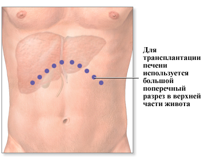 Пересадка печени: виды, выбор донора, ход процедуры.