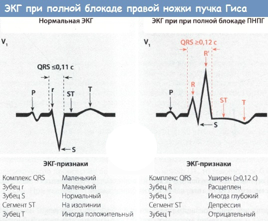 Чем опасна блокада ножек пучка гиса и как ее лечить
