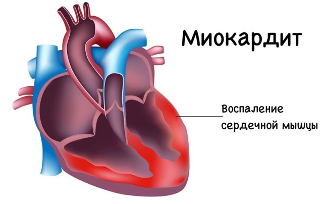 Как отличить сердечную боль от остеохондроза