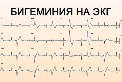 Экстрасистолы по типу бигеминии