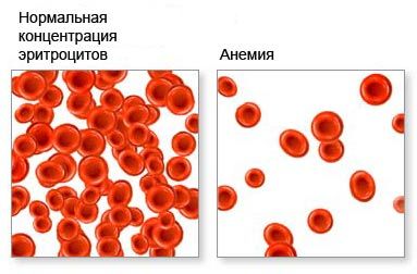 Большой разговор с врачом о железодефицитной анемии - кровь - Натуральная медицина