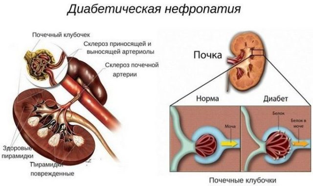 Ингибиторы АПФ: список препаратов при гипертонии. Ингибиторы АПФ – что это такое?