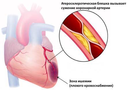 Что такое ИБС?