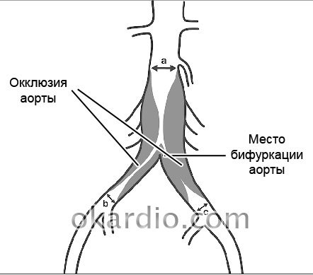Синдром Лериша: развитие, симптомы, лечение, прогноз