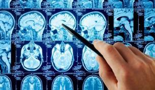 Ишемический инсульт - причины, симптомы, диагностика и лечение