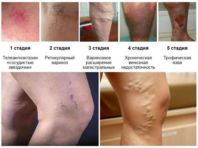 Сколько пить детралекс при варикозе на сайте варикоз