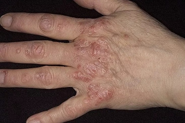 Лечение псориаз на руках - фото, симптомы, виды псориаза на руках