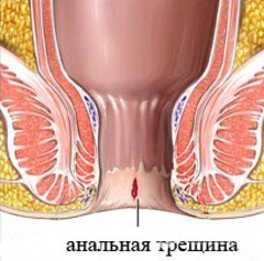 Трещина прямой кишки: симптомы, диагностика, лечение