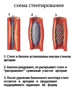 Операция на сонной артерии при атеросклерозе