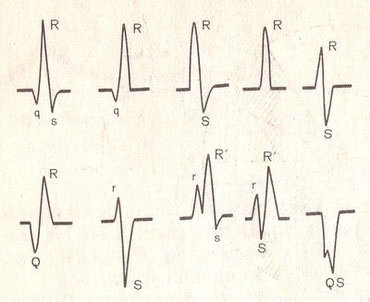 Стандартные отведения от конечностей - 1,2,3